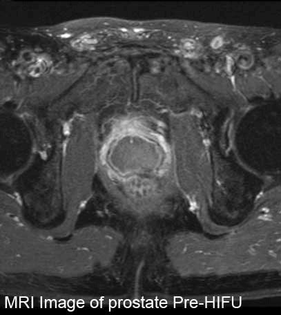 MRI Image of Prostate HIFU